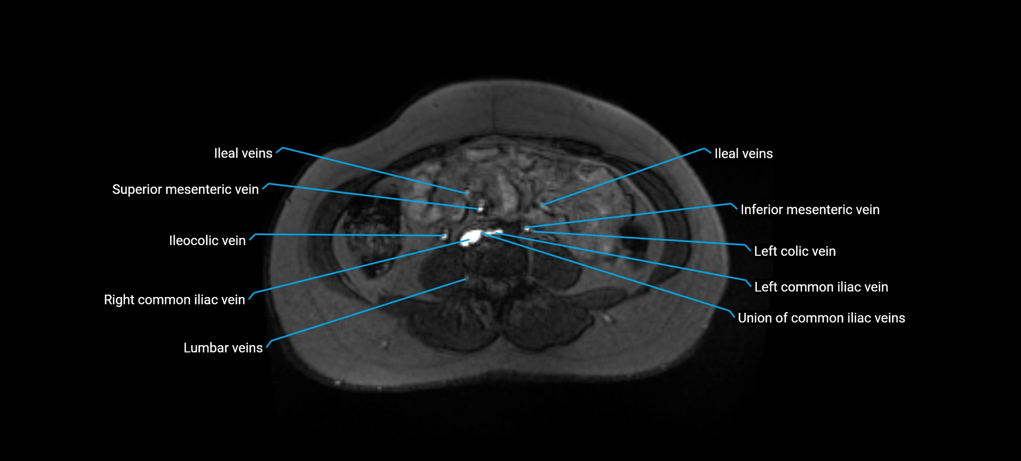 MRV abdomen pelvis & lower limb axial cross sectional anatomy labelled MRI image 108 (1).webp